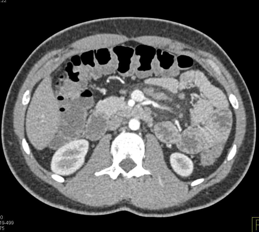Mesenteric Nodes due to Mycobacterium avium/intracellulare (MAI) Infection - CTisus CT Scan