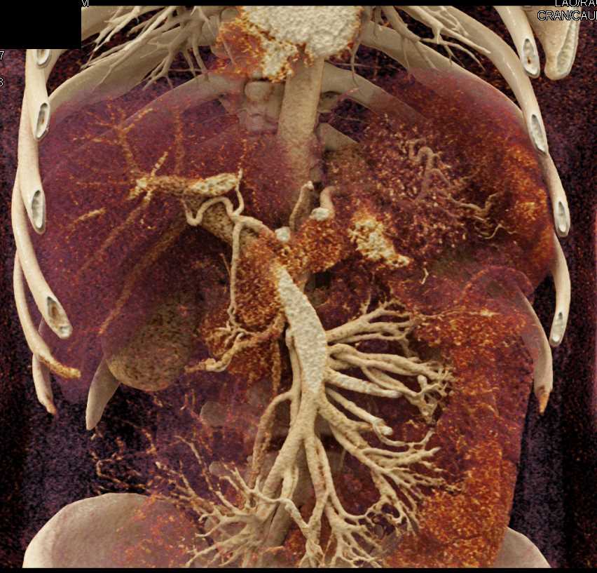 Mesenteric Nodes due to Mycobacterium avium/intracellulare (MAI) Infection - CTisus CT Scan