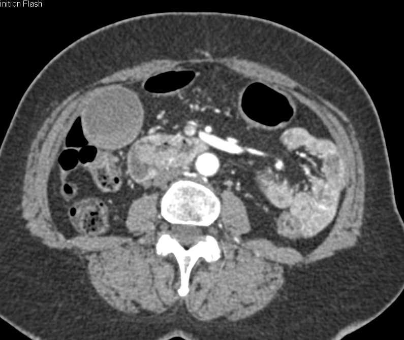 Duodenal Carcinoma Obstructs the Common Bile Duct (CBD) - CTisus CT Scan