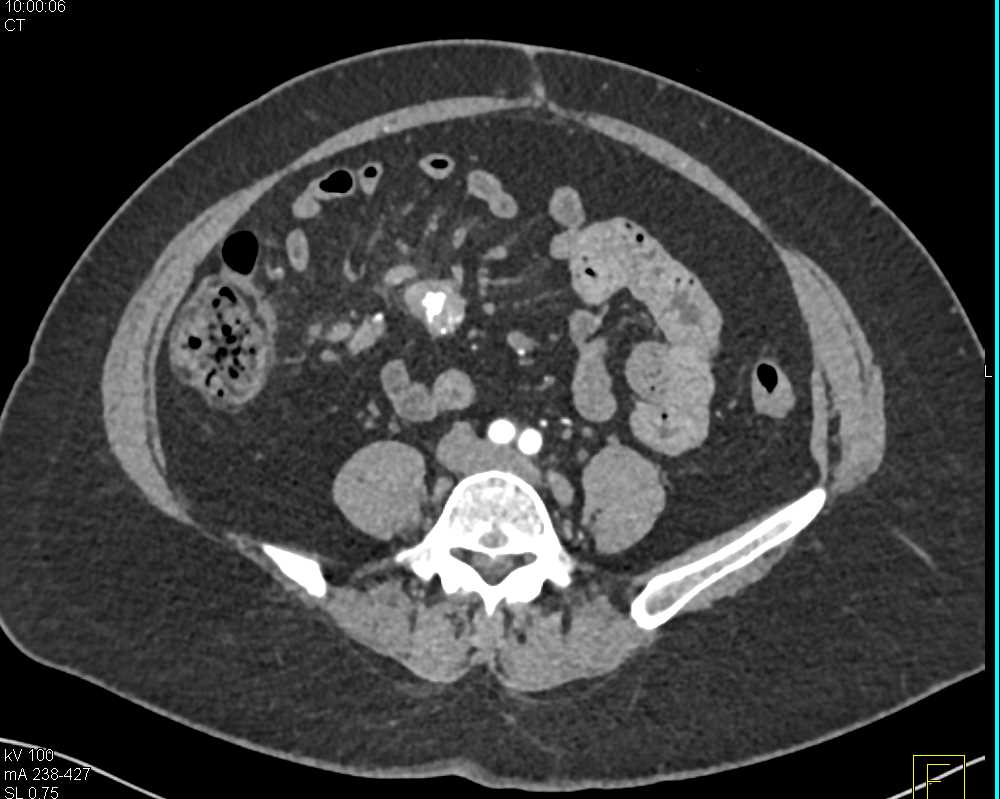 Carcinoid in the Root of the Mesentery - CTisus CT Scan
