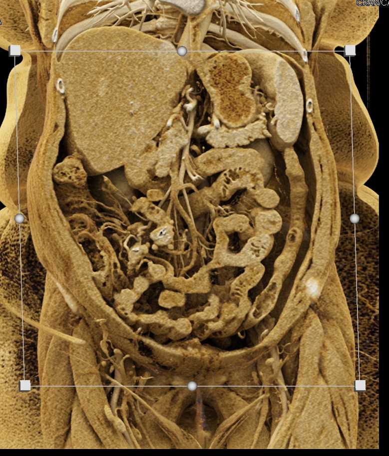 Carcinoid in the Root of the Mesentery - CTisus CT Scan