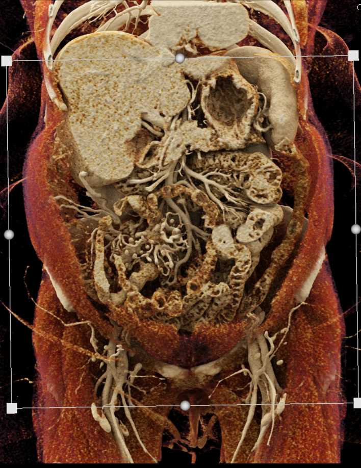 Carcinoid in the Root of the Mesentery - CTisus CT Scan