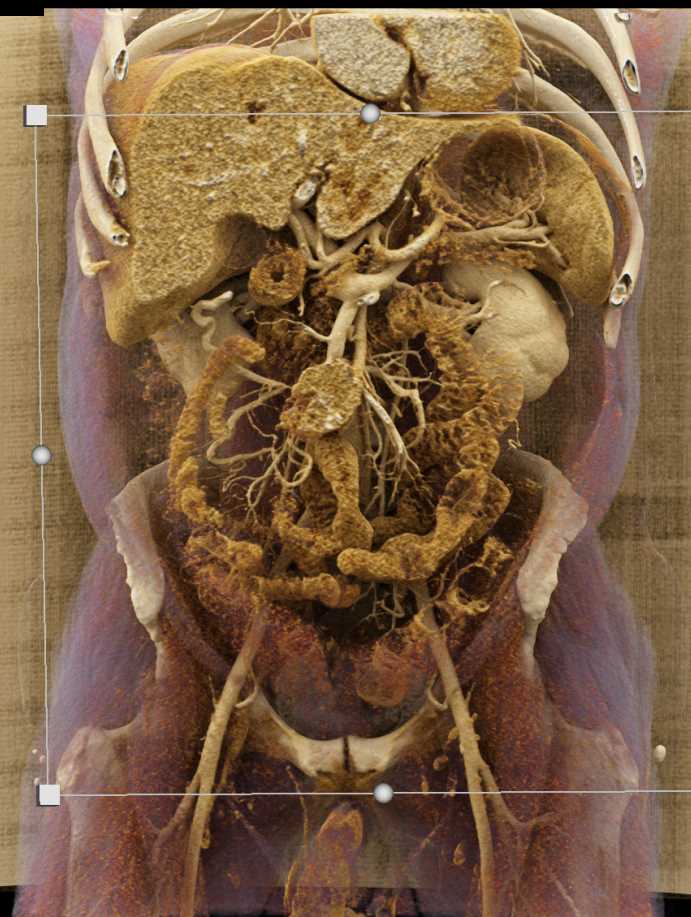 Carcinoid Tumor Root of Mesentery with Liver Metastases using Cinematic Rendering - CTisus CT Scan