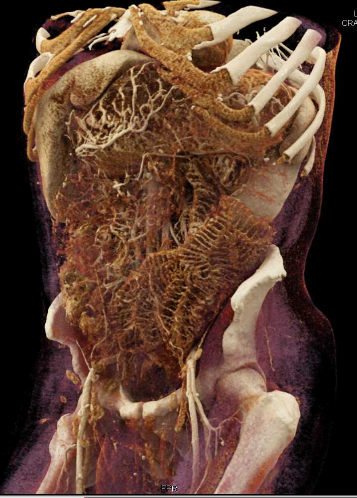 Dilated Small Bowel with Cinematic Rendering - CTisus CT Scan