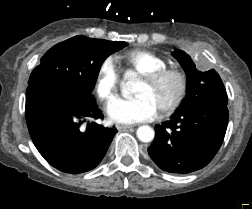 Duodenal Adenocarcinoma with Bone Metastases - CTisus CT Scan