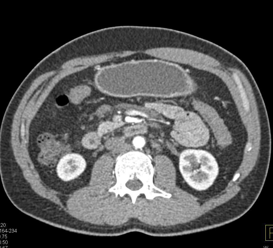 Mesenteric Adenopathy - CTisus CT Scan