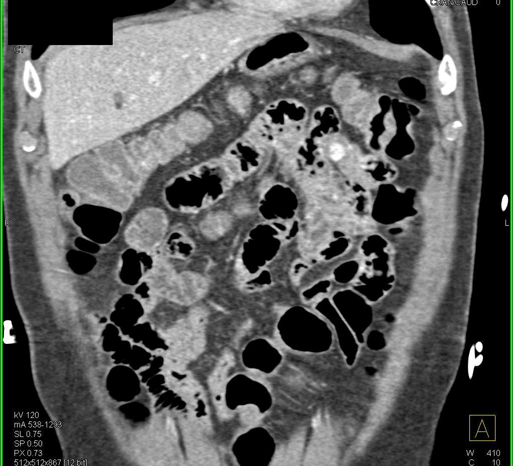 1cm Carcinoid Tumor in the Jejunum - CTisus CT Scan