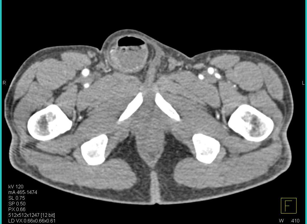 Small Bowel Obstruction (SBO) due to Inguinal Hernia - CTisus CT Scan