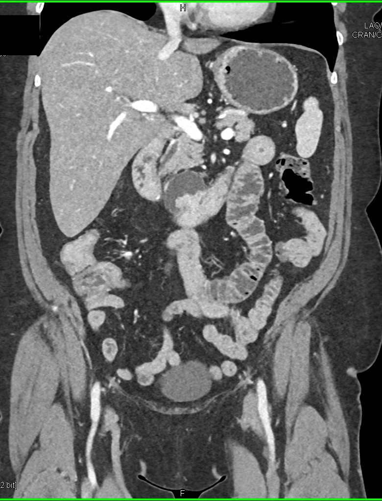 Carcinoma In a Duodenal Diverticulum - CTisus CT Scan