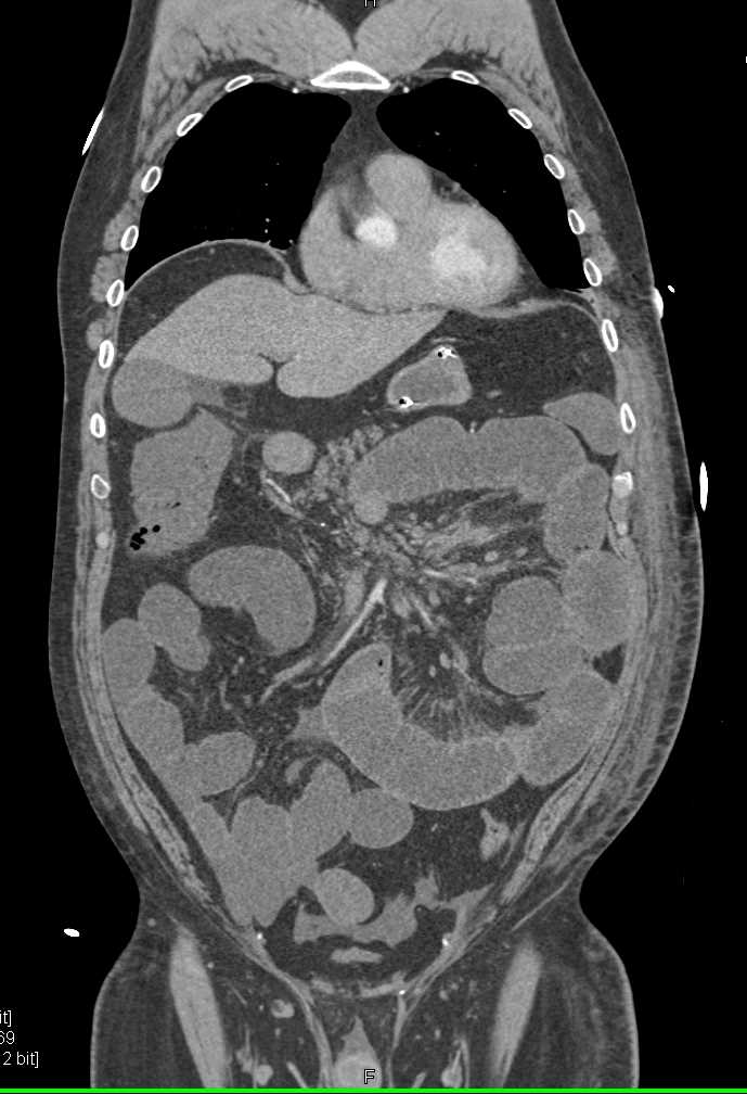 Carcinoid Tumor in the Mesentery - CTisus CT Scan