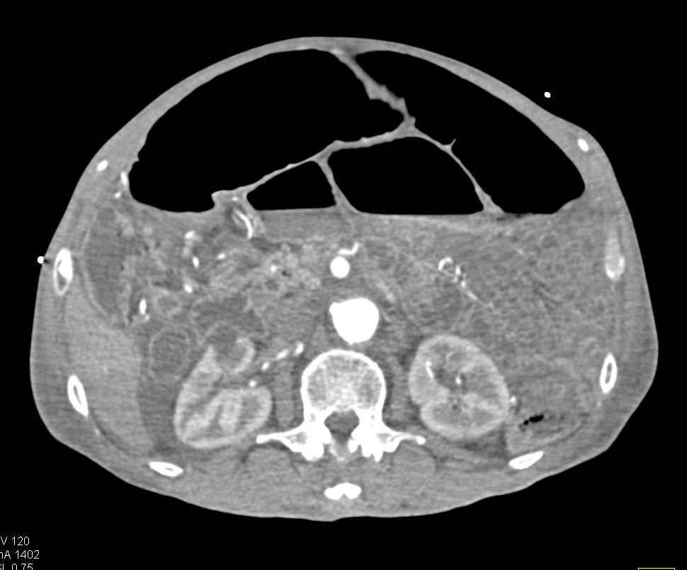 Vasculitis Involves the Superior Mesenteric Artery (SMA) - CTisus CT Scan