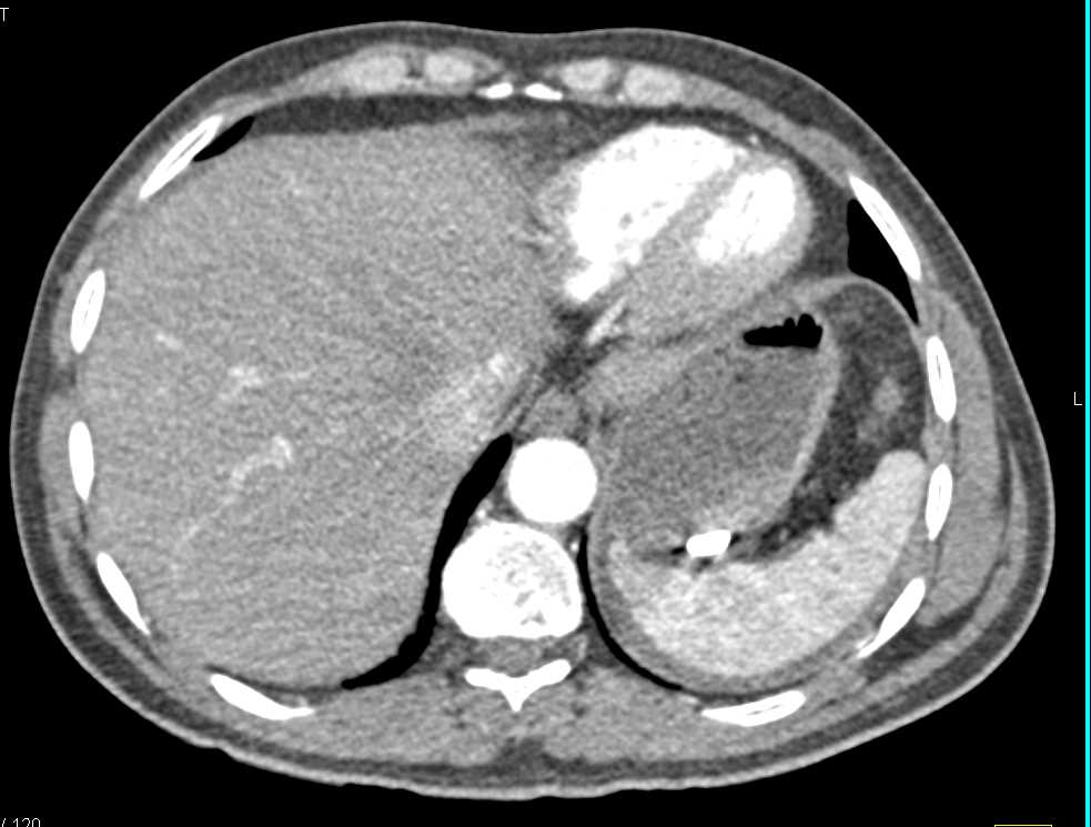 SBO with Midgut Volvulus - CTisus CT Scan