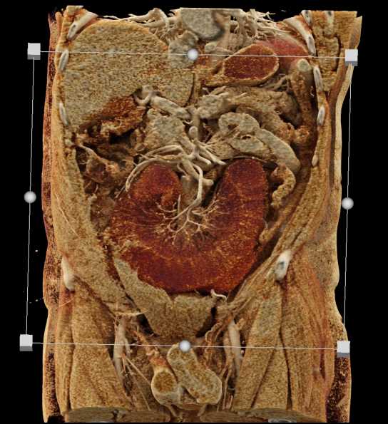 Ischemic Small Bowel with Midgut Volvulus with Cinematic Rendering - CTisus CT Scan