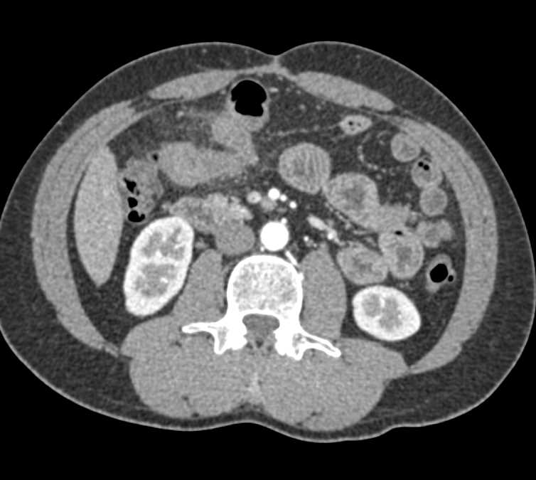 Small Bowel Obstruction (SBO) with Thickened Small Bowel Folds - CTisus CT Scan