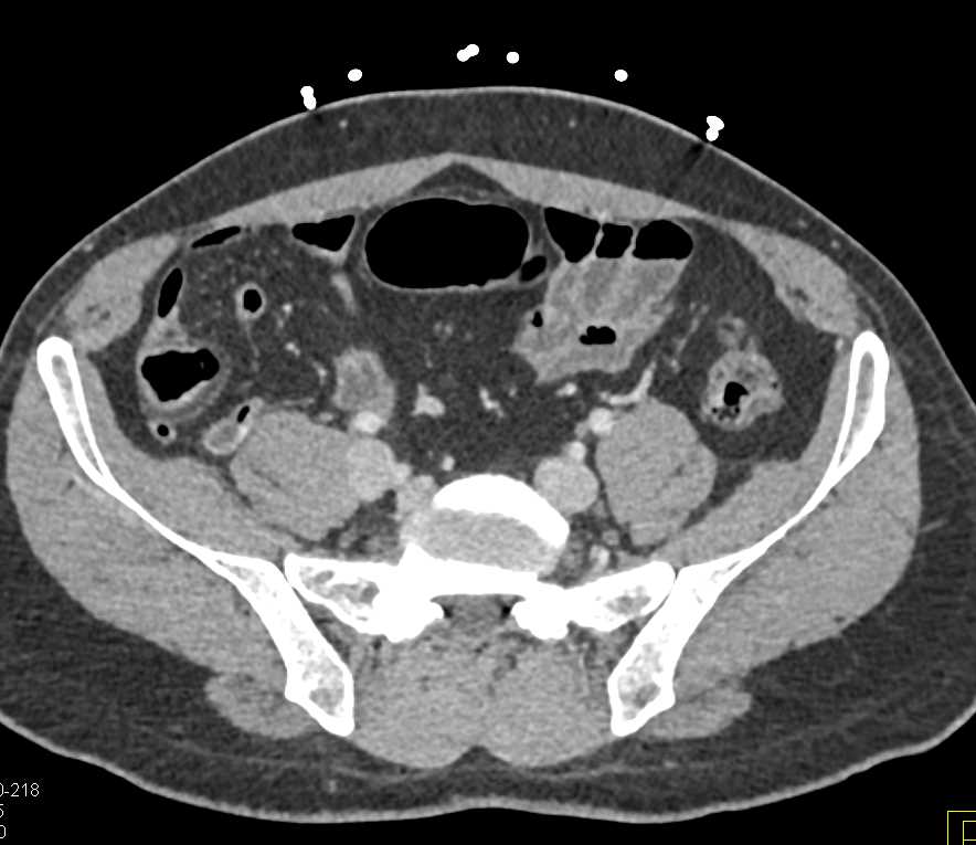 Crohn's Disease Terminal Ileum - CTisus CT Scan
