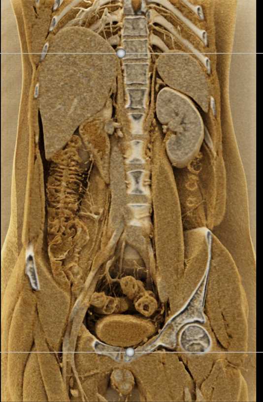 Crohns Disease Terminal Ileum - CTisus CT Scan