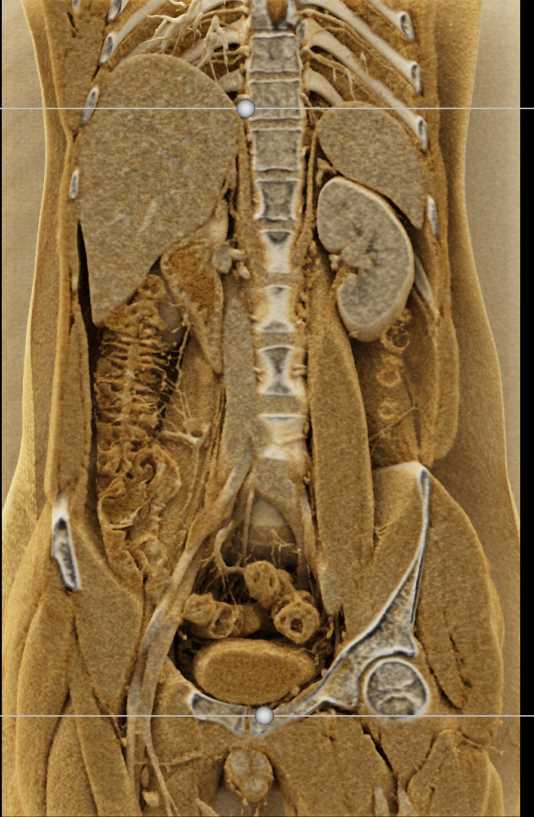 Crohn's Disease Terminal Ileum - CTisus CT Scan