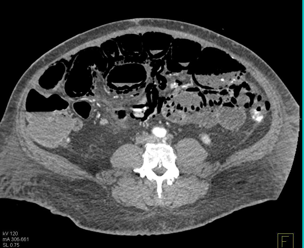 Ischemic Bowel with Pneumatosis - CTisus CT Scan