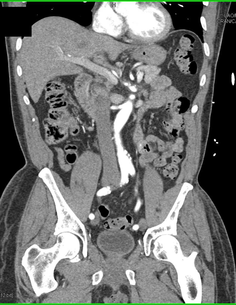 GI Bleed in Jejunum - CTisus CT Scan