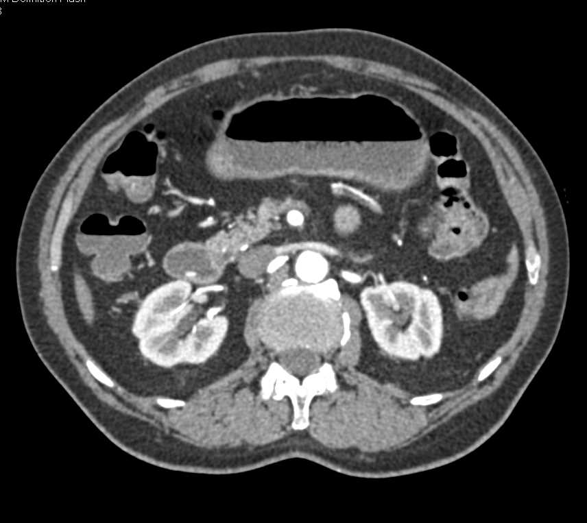 Pill in Duodenum Simulates a Bleed - CTisus CT Scan