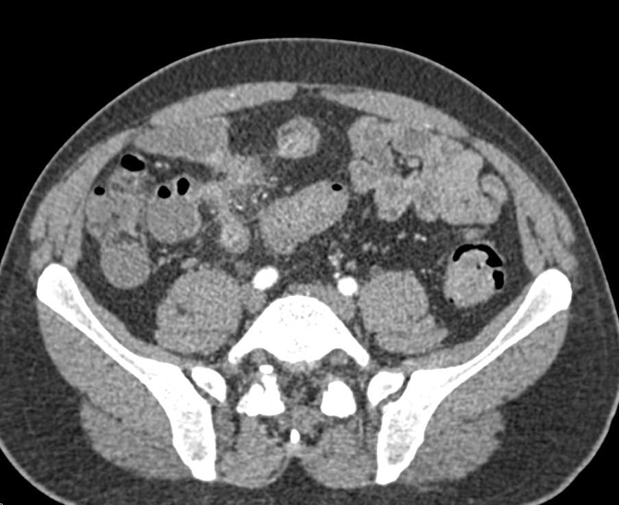 Crohn's Disease with Enetero-Enteric Fistulae - CTisus CT Scan