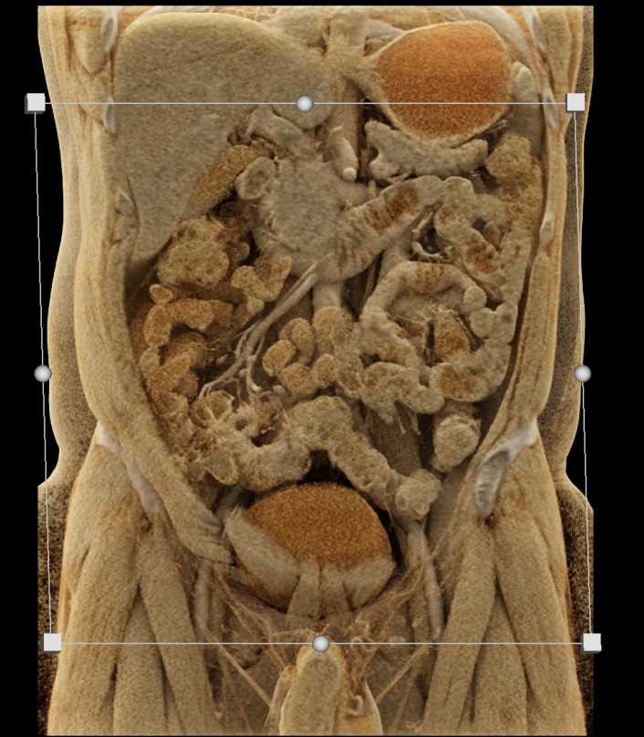 Crohn's Disease with Enetero-Enteric Fistulae - CTisus CT Scan