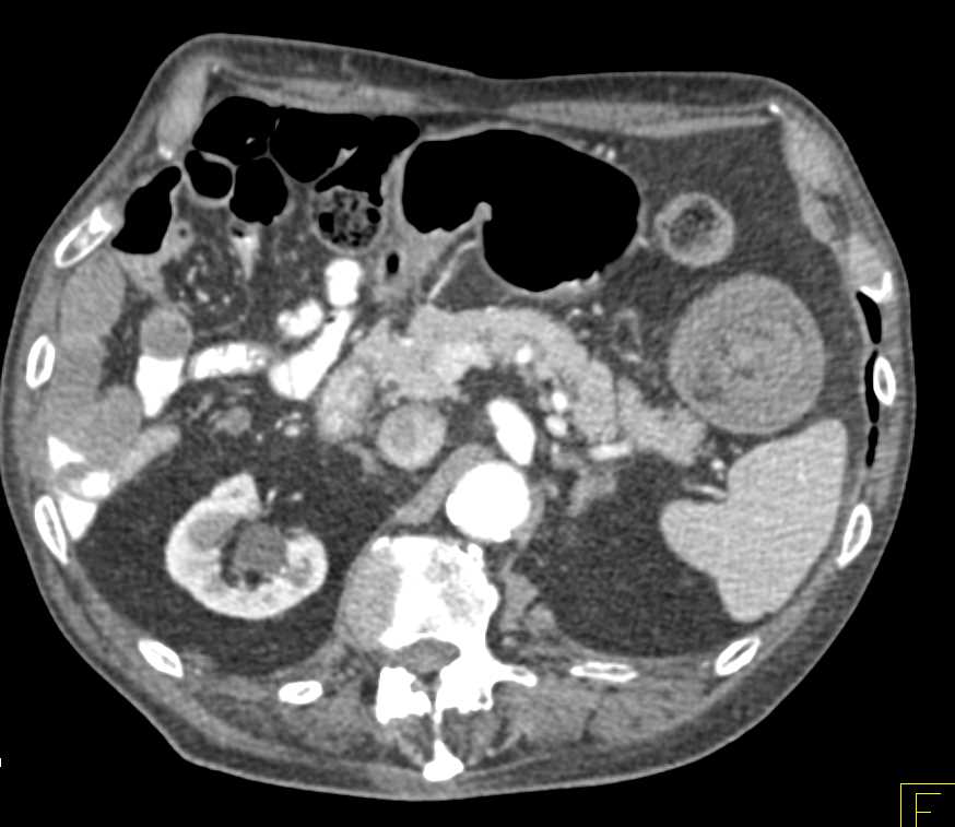 Small Bowel Intussusception Jejunum - CTisus CT Scan