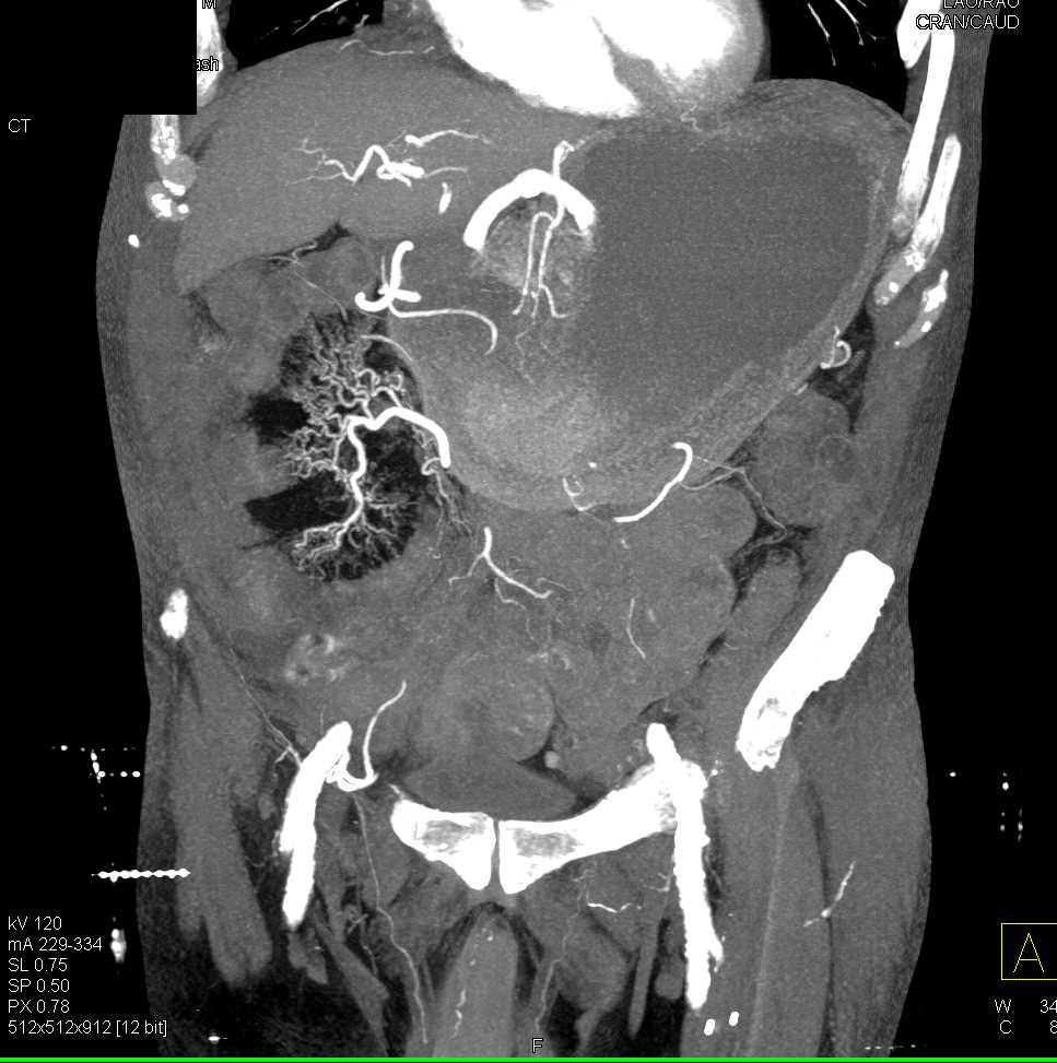 Crohn's Disease with Mesenteric Fat in RLQ - CTisus CT Scan
