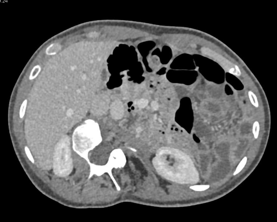 Small Bowel LUQ is Dilated - CTisus CT Scan