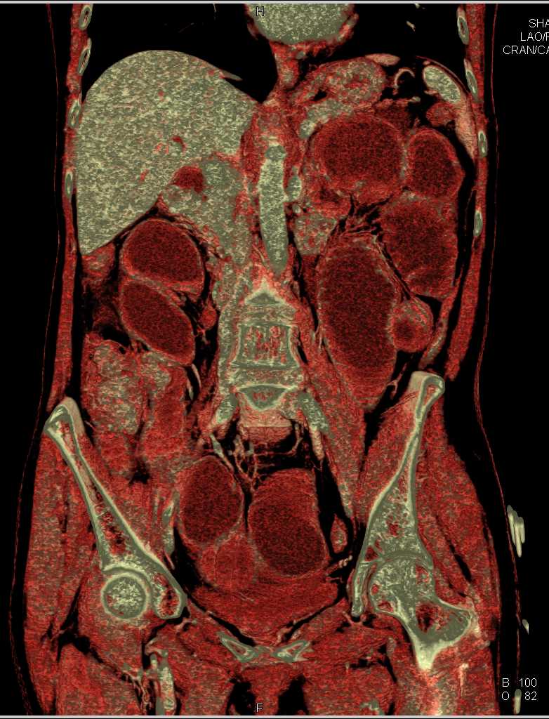 Distal Small Bowel Obstruction - CTisus CT Scan