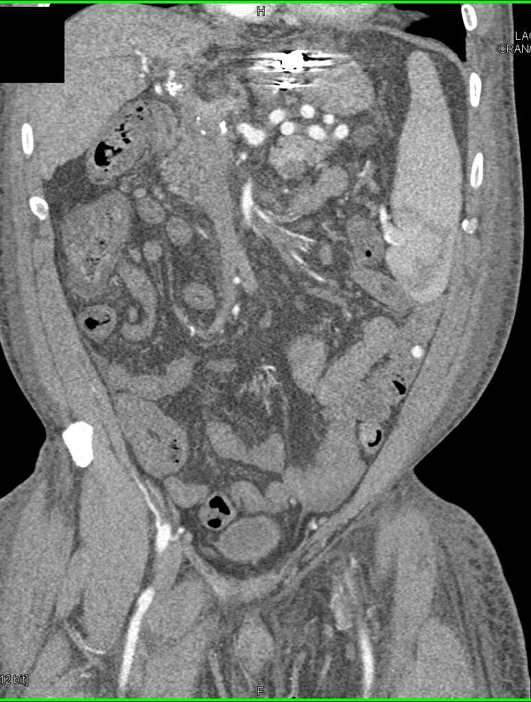 Crohns Disease Small Bowel - CTisus CT Scan