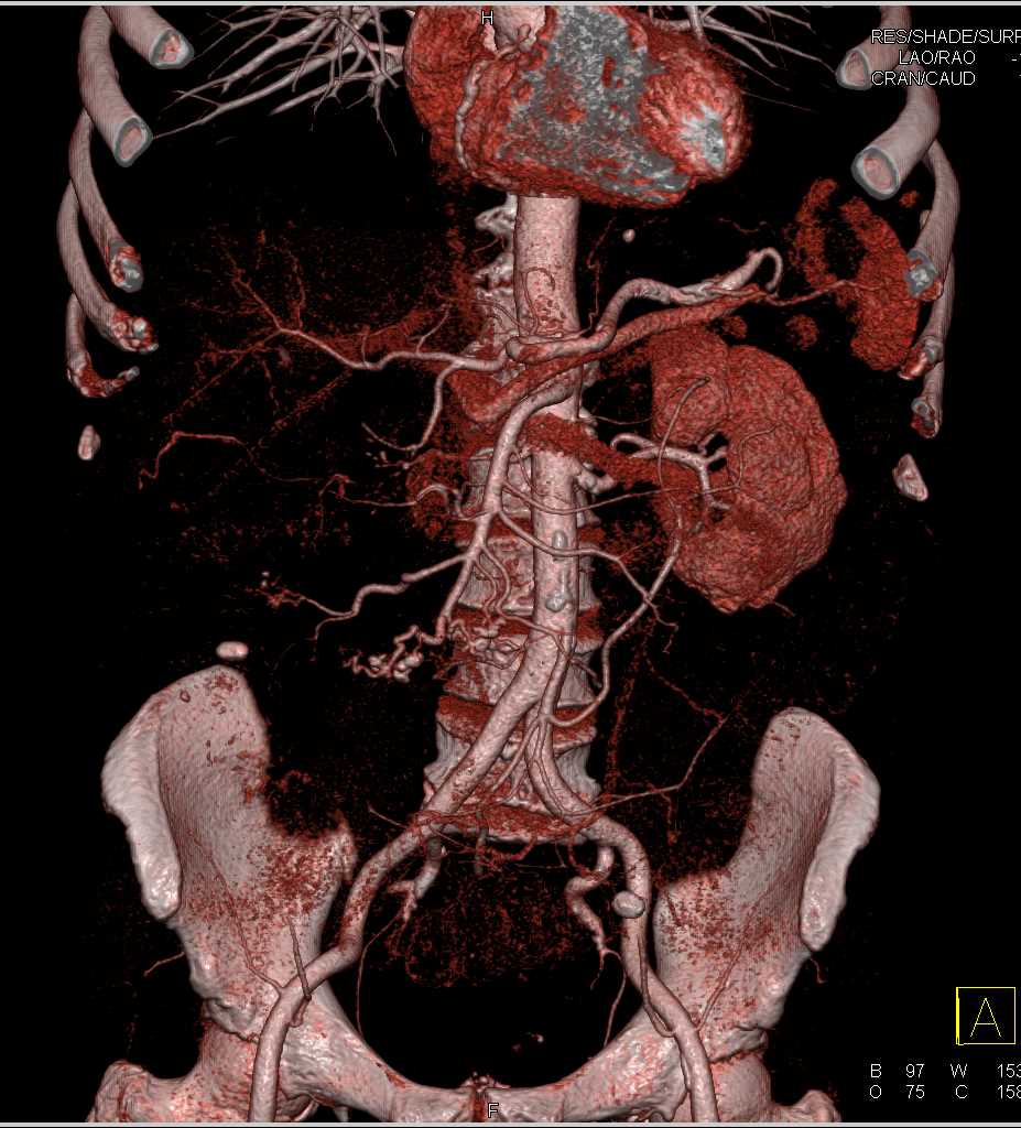 Crohns Disease Small Bowel - CTisus CT Scan