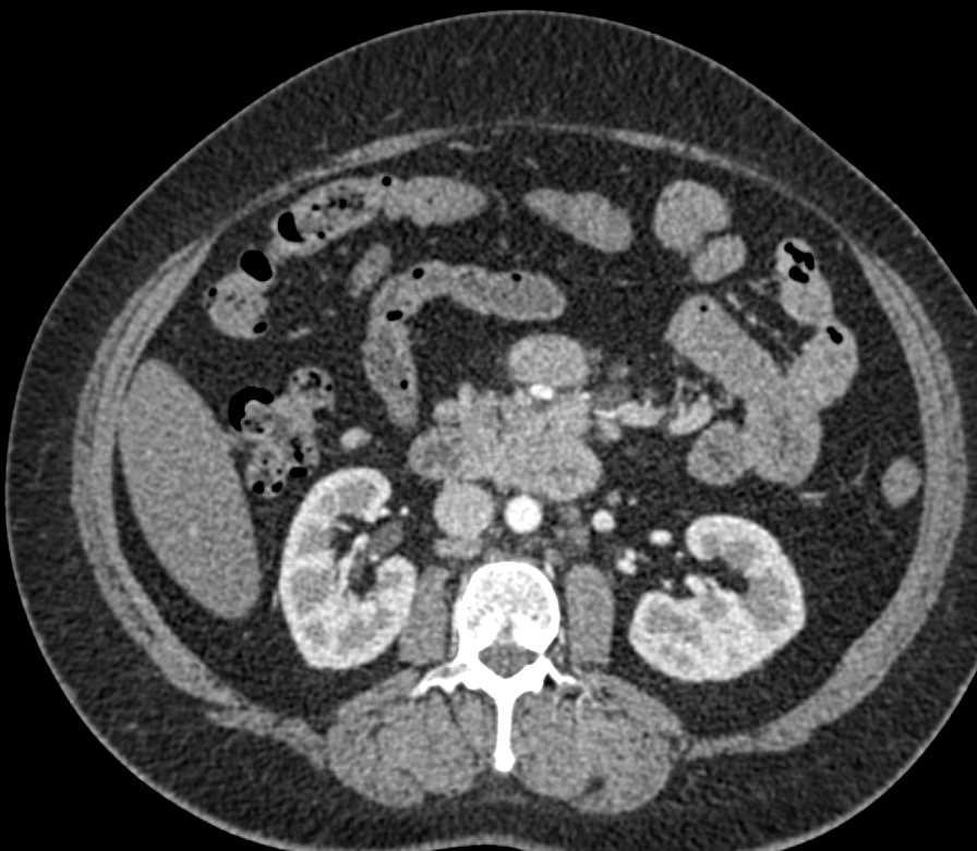 Carcinoid Tumor 4th Portion Duodenum - CTisus CT Scan