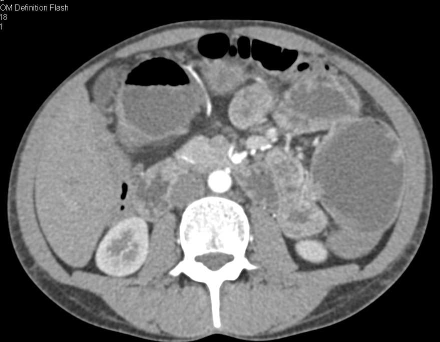 Distal Small Bowel Obstruction with Stenosis due to Crohns Disease - CTisus CT Scan