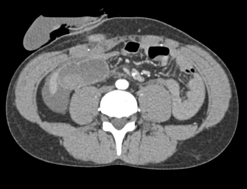 Small Bowel Bleed - CTisus CT Scan
