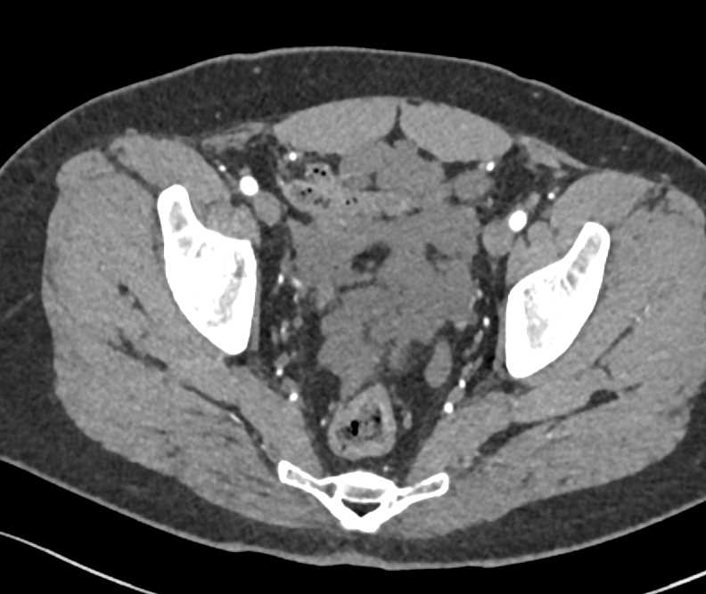 Carcinomatosis Involves the Pelvis - CTisus CT Scan