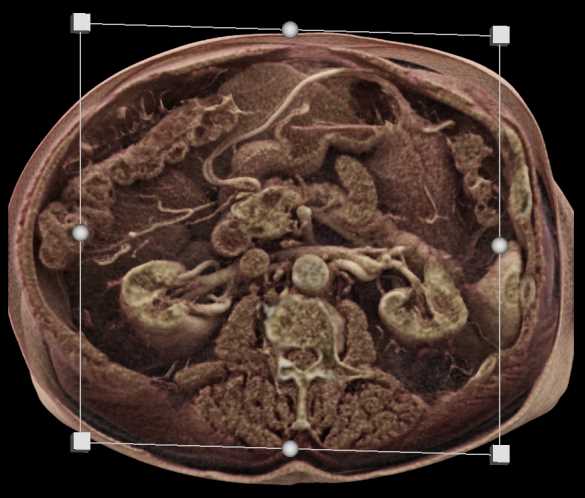 Carcinomatosis Involves the Pelvis - CTisus CT Scan