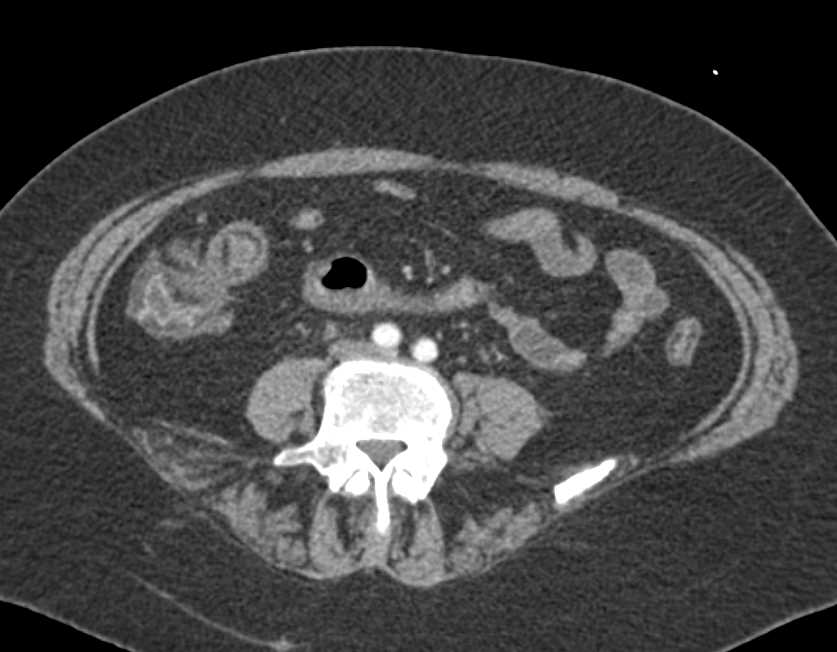 Crohns Disease - CTisus CT Scan