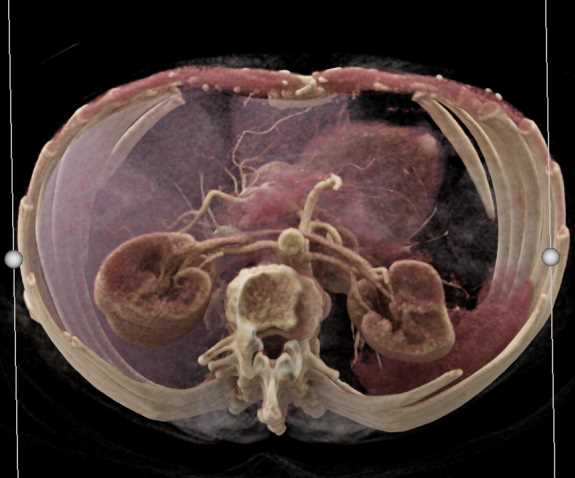 Crohns Disease - CTisus CT Scan