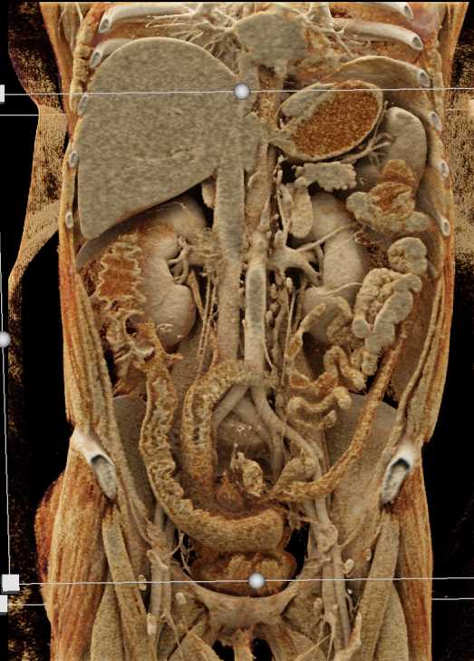 Crohns Disease - CTisus CT Scan