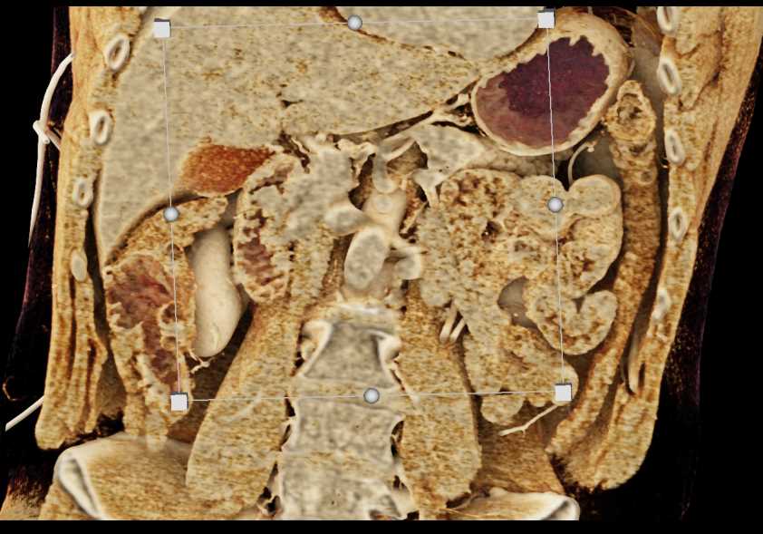 Ampullary Lesion in the Duodenum - CTisus CT Scan