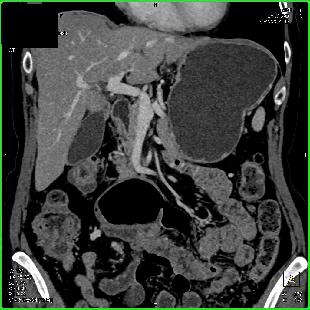 Dilated Duodenum - CTisus CT Scan