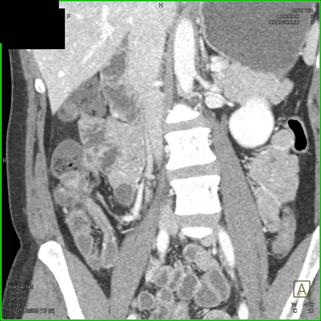 Crohns Disease Terminal Ileum - CTisus CT Scan