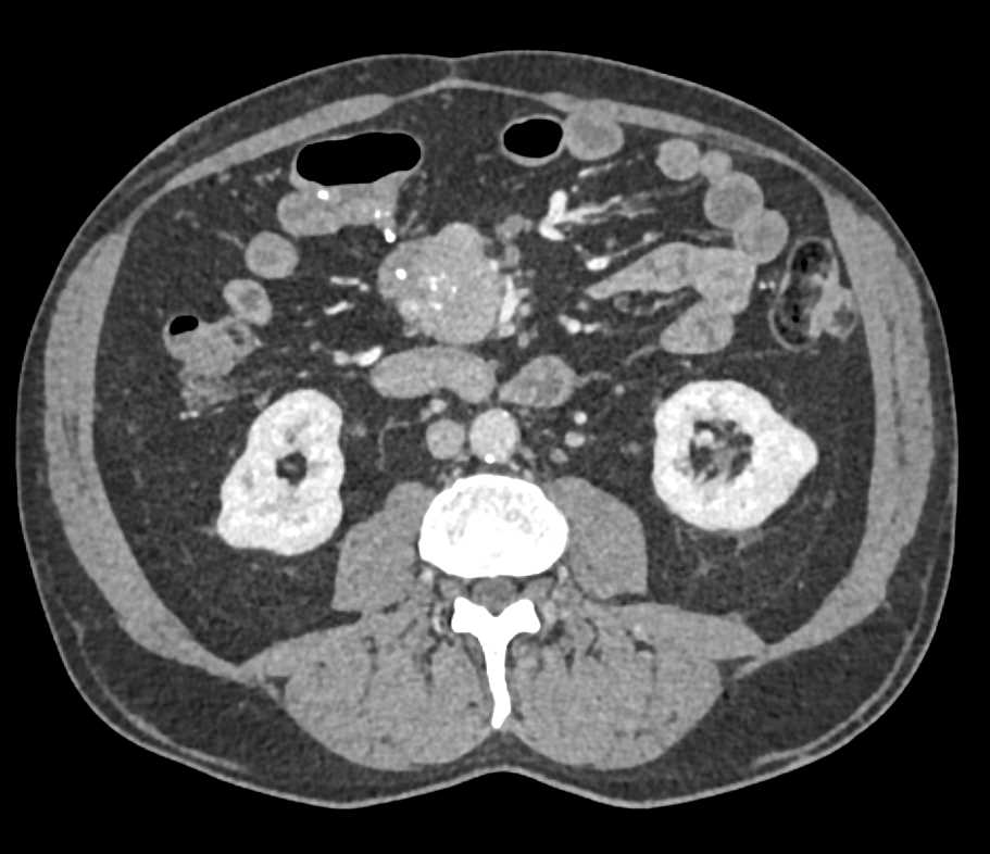 Carcinoid Tumor with Desmoplastic Reaction - CTisus CT Scan