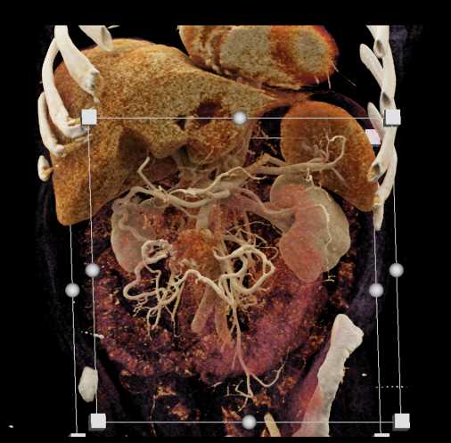 Carcinoid Tumor with Desmoplastic Reaction - CTisus CT Scan
