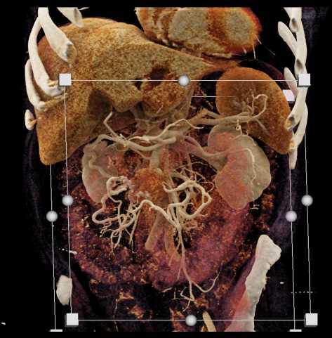 CTisus CT Scanning | Carcinoid Tumor with Desmoplastic Reaction