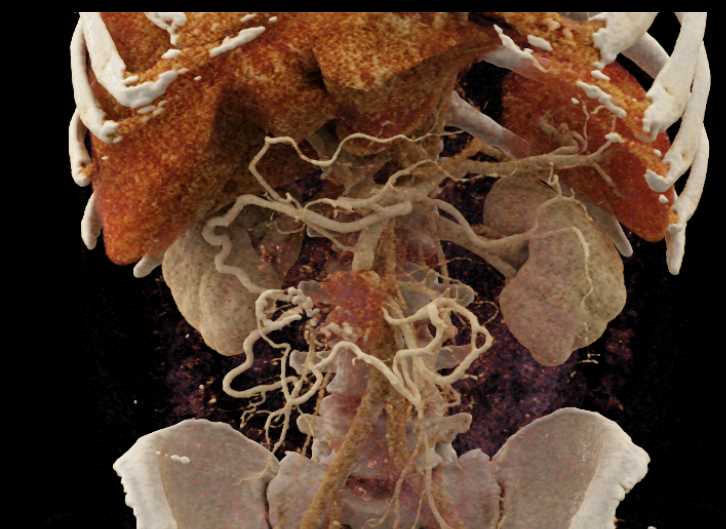 Carcinoid Tumor with Desmoplastic Reaction - CTisus CT Scan