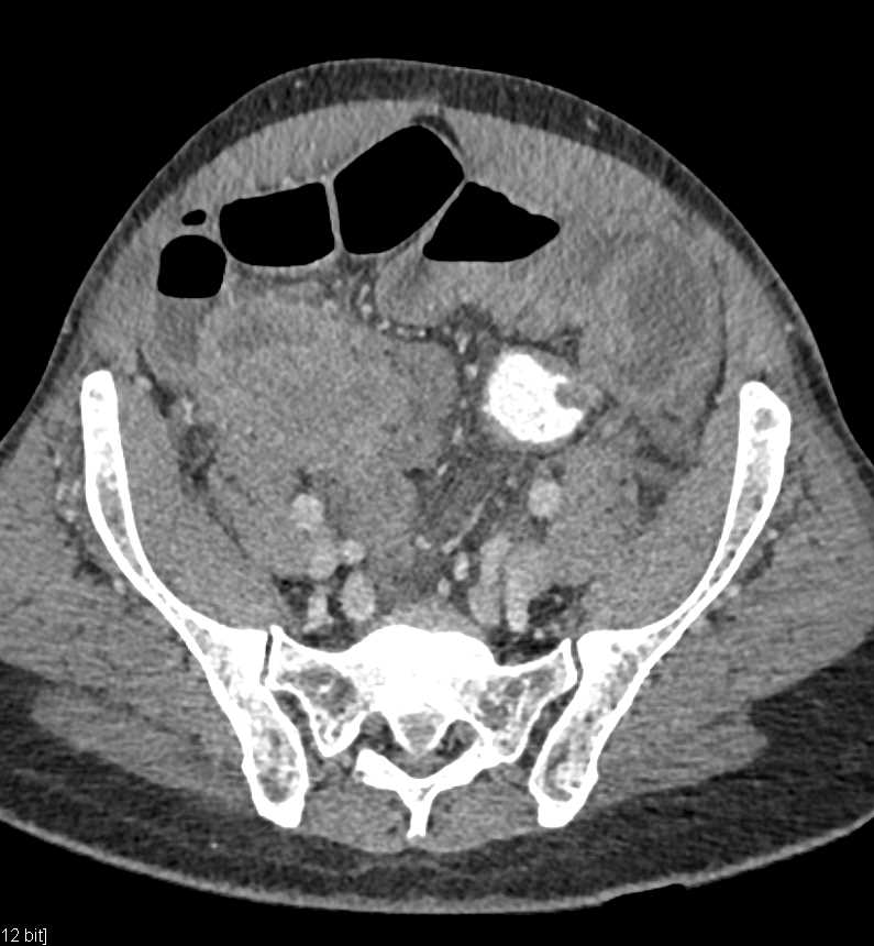 CTisus CT Scanning | Small Bowel Carcinoma with Carcinomatosis