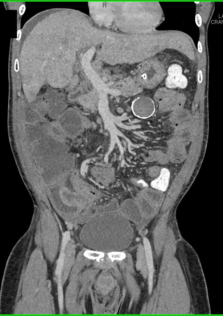 Small Bowel Carcinoma with Carcinomatosis - CTisus CT Scan