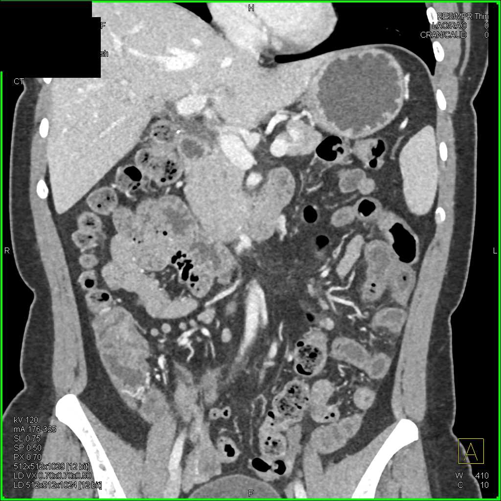 Enteritis Involves the Jejunum - CTisus CT Scan
